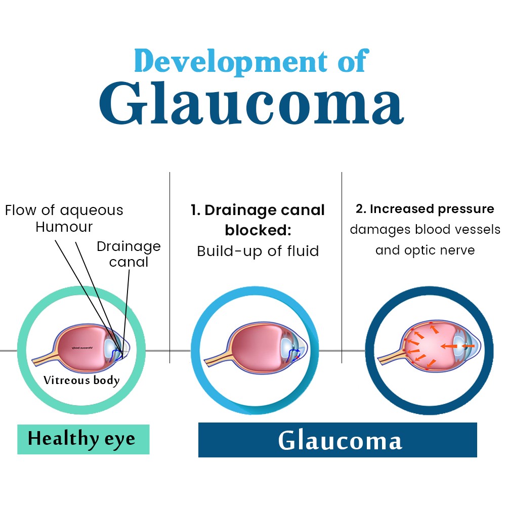Development-of-Glaucoma-jpg