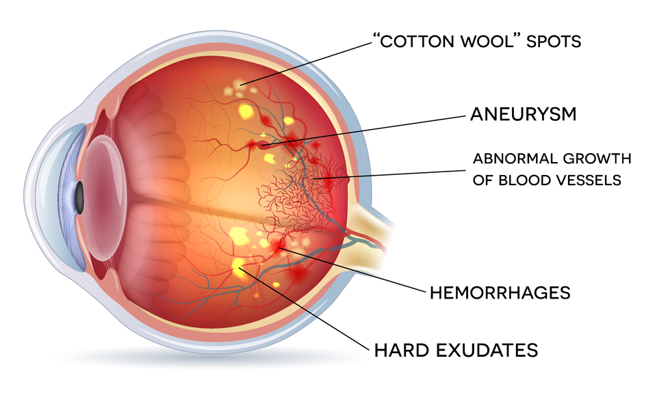 Exeter-Eye-Diabetic-Retinopathy-side-view-of-eye-diagram