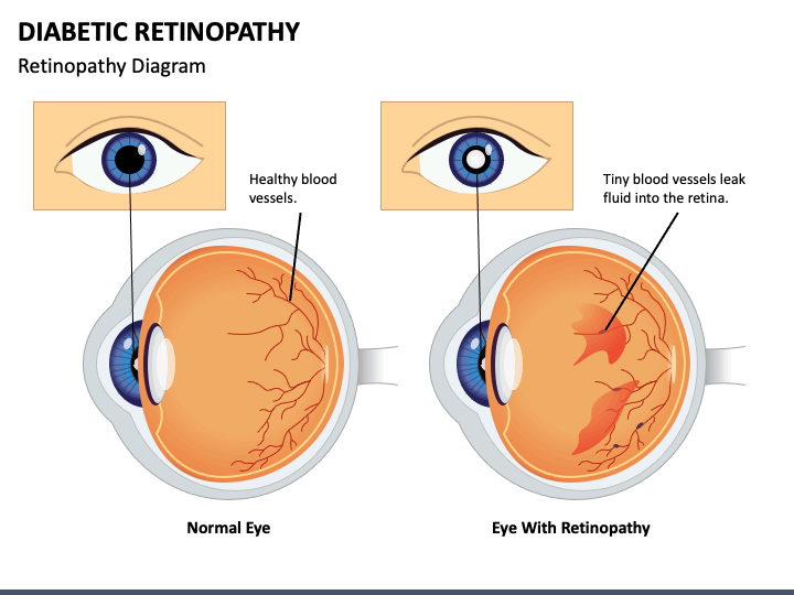 diabetic-retinopathy-mc-slide1