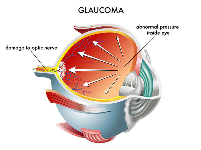 glaucoma-chart-2