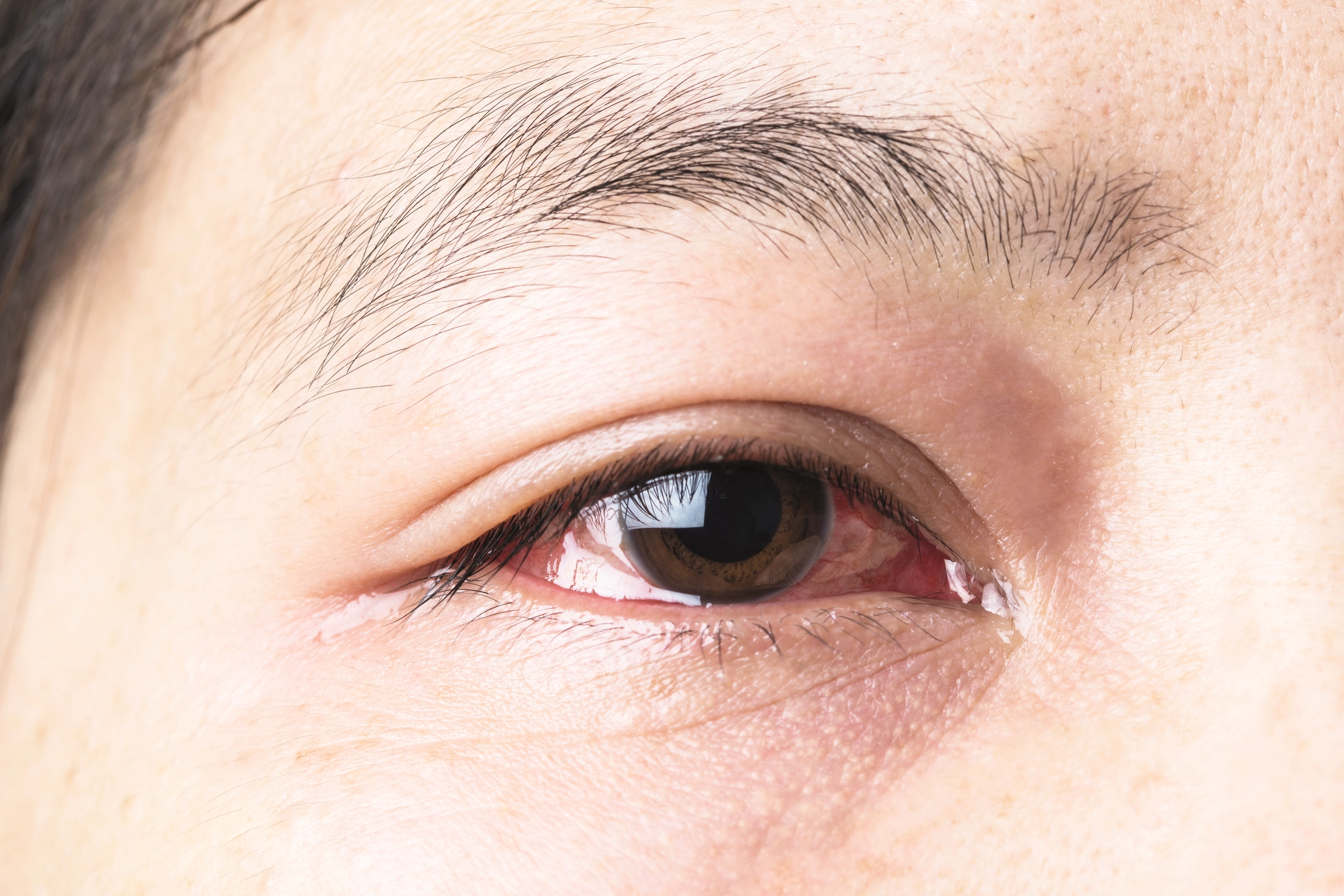 Common Eye Conditions and How to Prevent Them