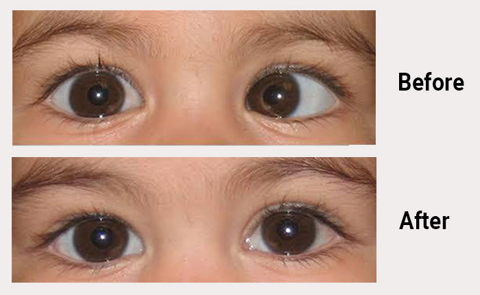 squint-eye-1