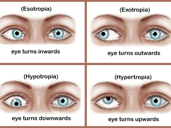 treatment of squint and orthoptics in Prayagraj by Dr. Ashish Mitra