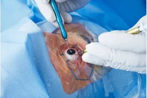 Eye_surgery Eye_surgery