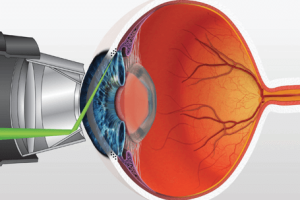 glaucoma-laser-surgery-melbourne glaucoma-laser-surgery-melbourne